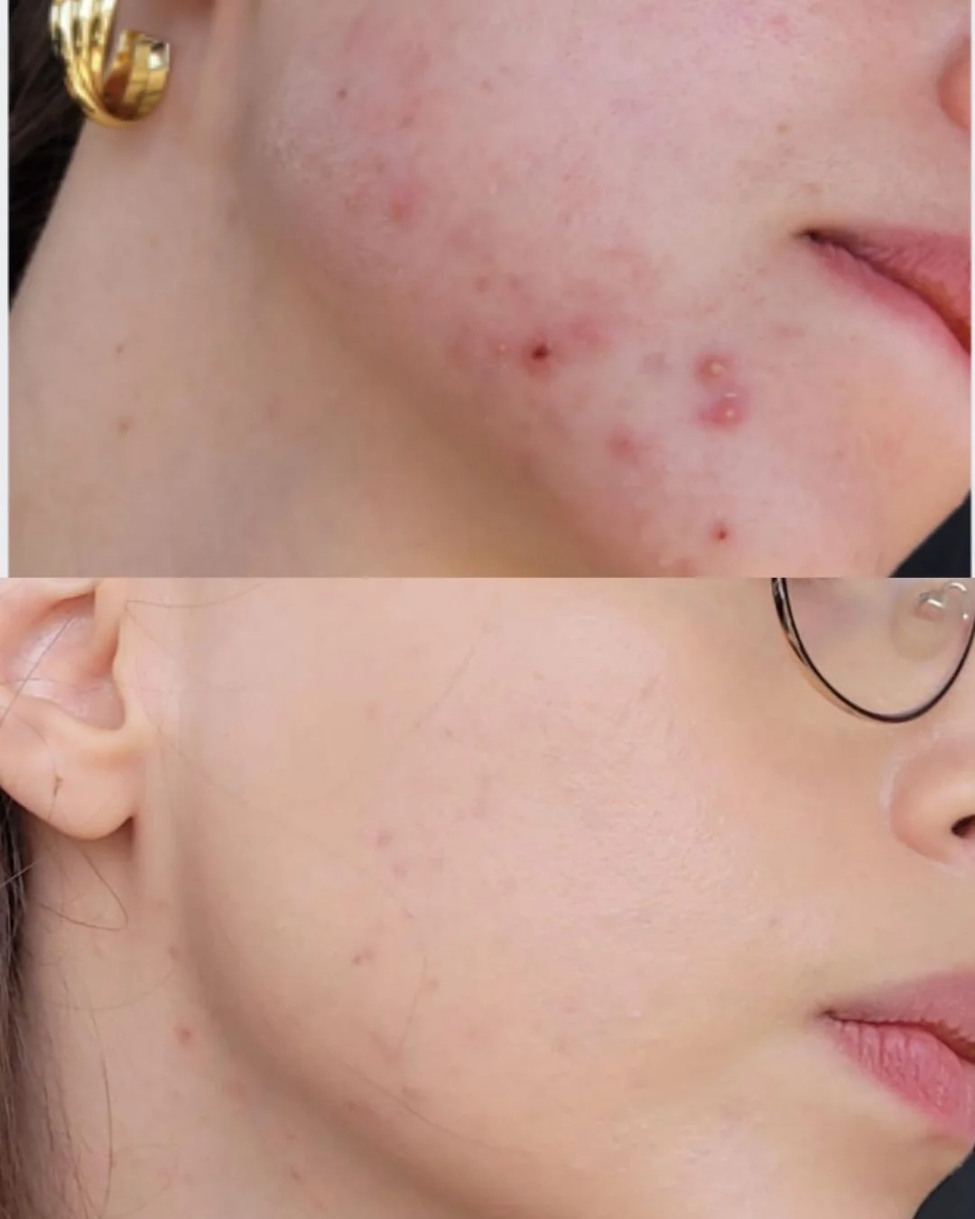 Resultado de paciente — antes e depois do acompanhamento integrativo para acne