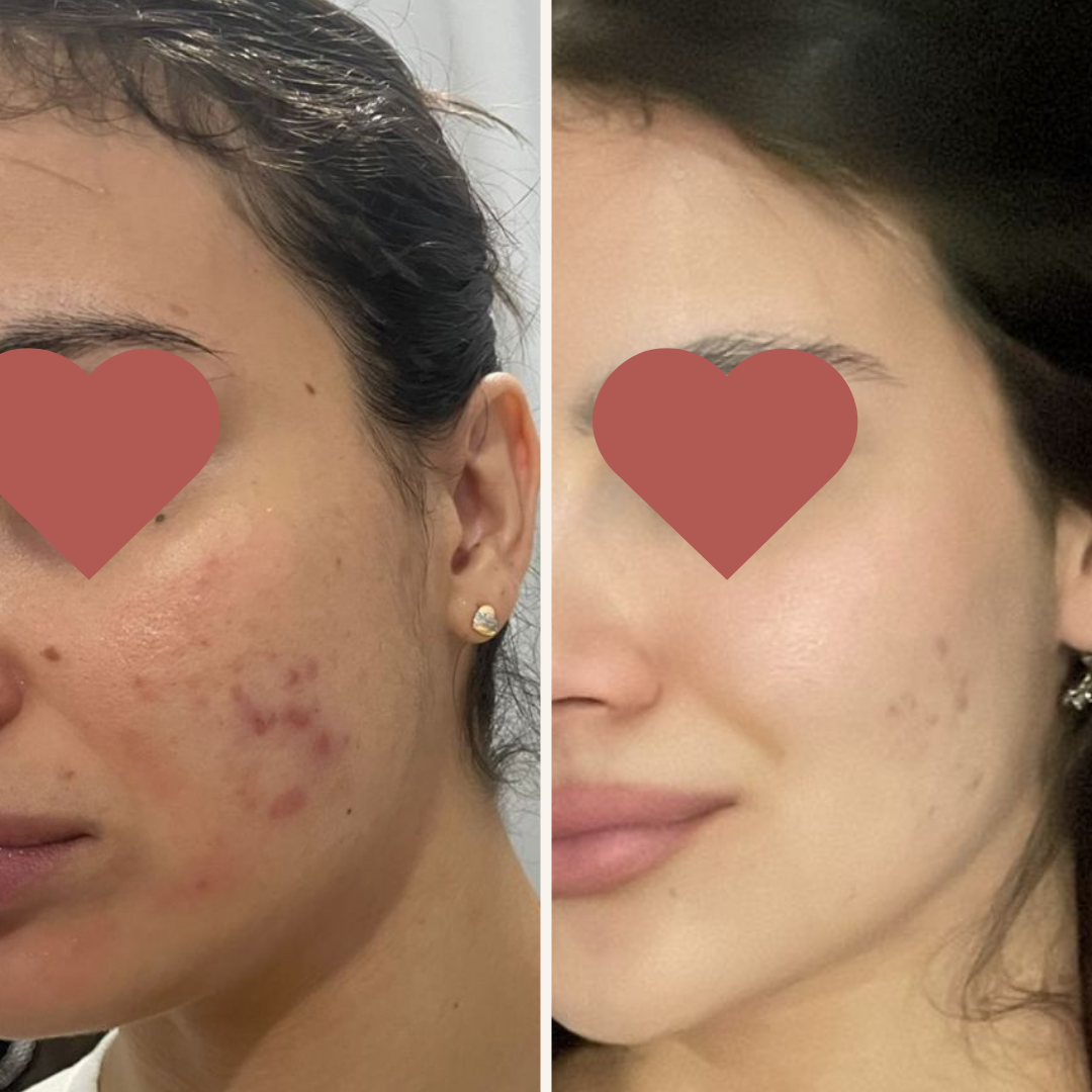 Resultados de tratamento de acne - antes e depois pele limpa