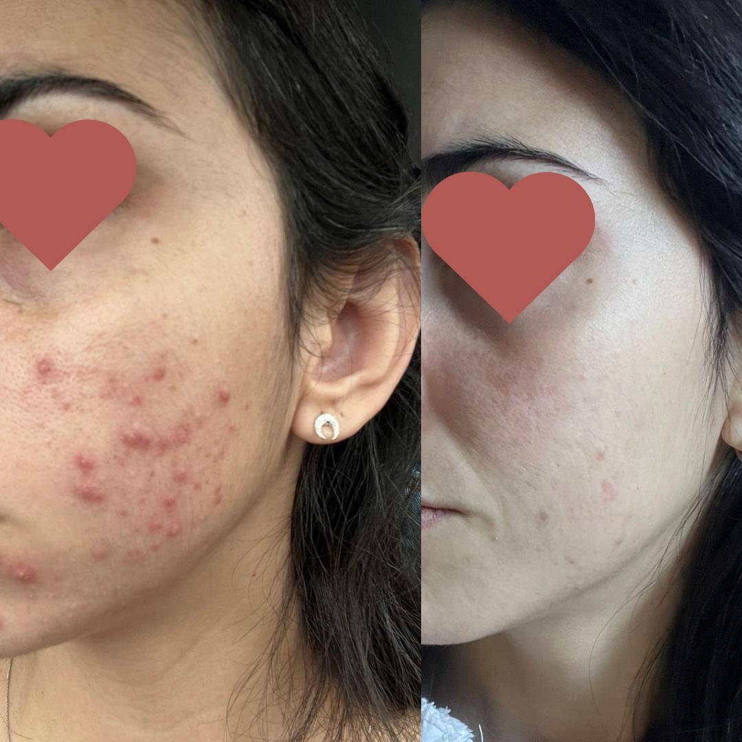 Tratamento de acne natural - resultados visíveis